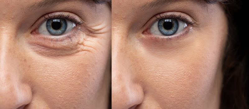 Avant après rajeunissement du regard et rajeunissement des yeux à Alger en Algérie