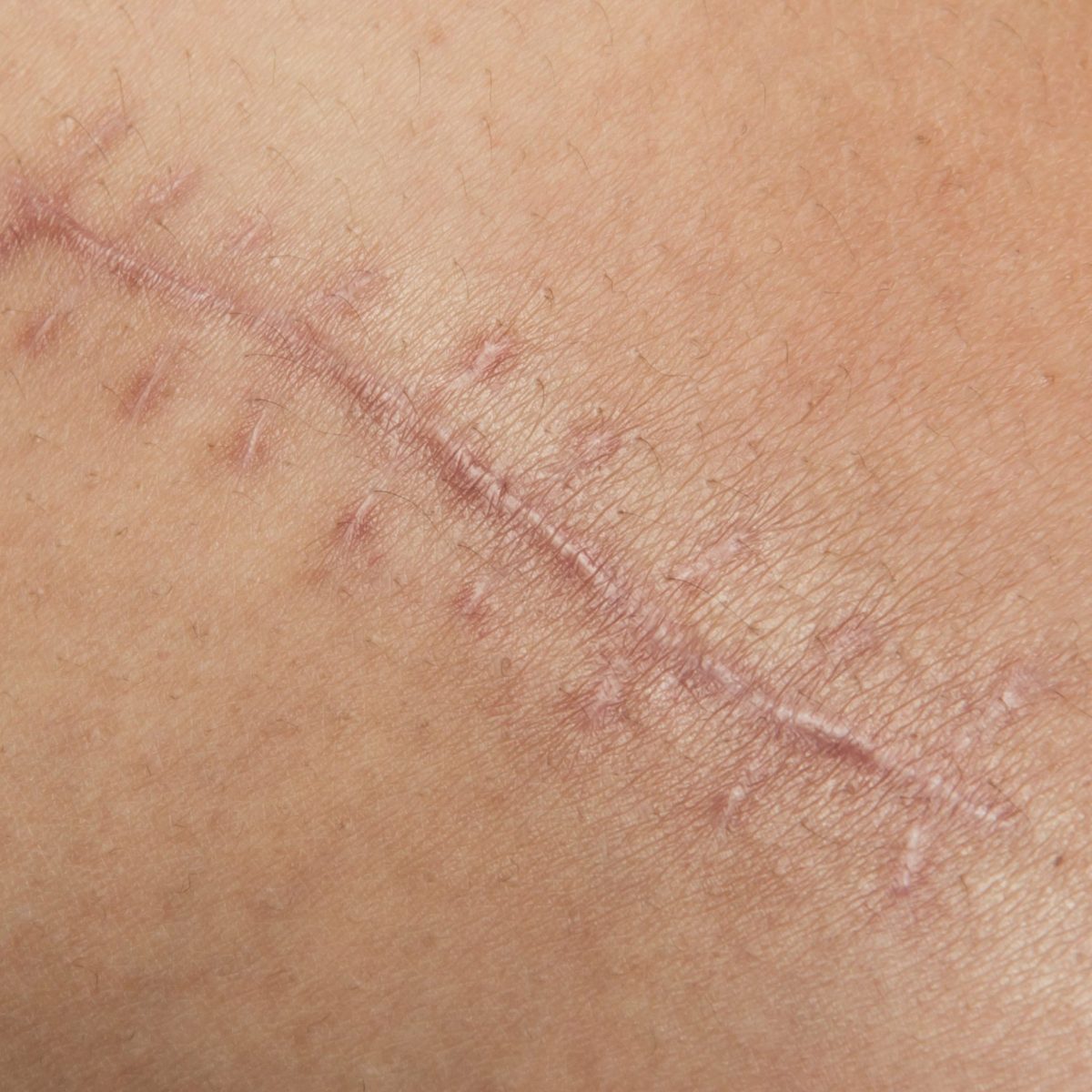 cicatrices-chirurgie